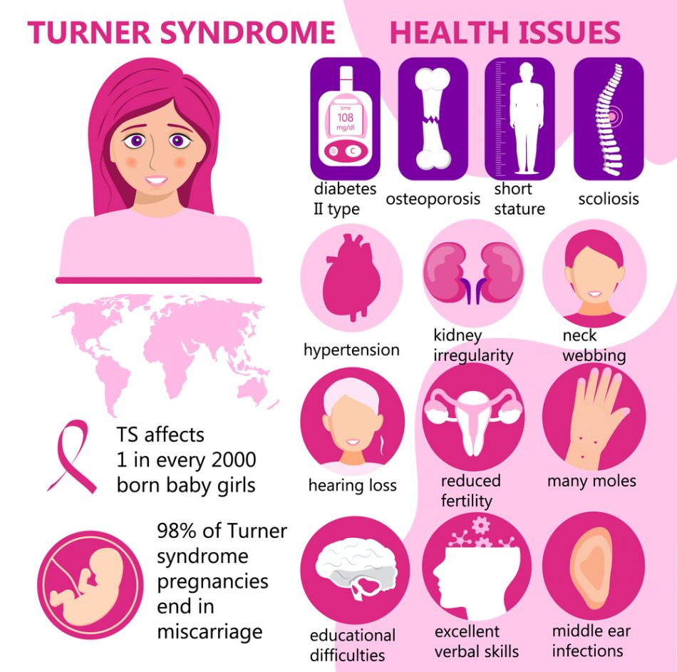 la-sindrome-di-turner-nel-neonato