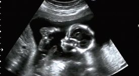 translucenza-nucale-lo-screening-per-le-anomalie-cromosomiche