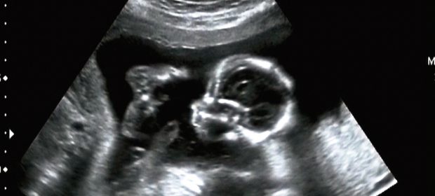translucenza-nucale-lo-screening-per-le-anomalie-cromosomiche