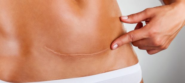 ho-fatto-due-cesarei-programmati-e-li-rifarei