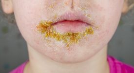 impetigine