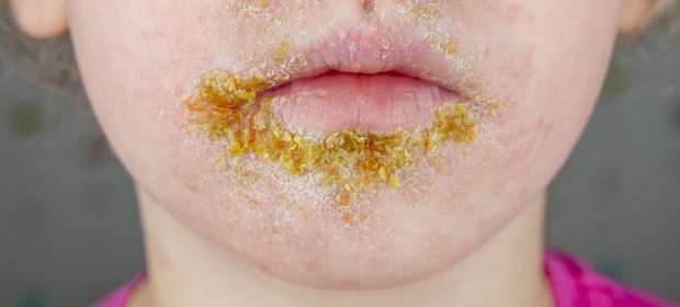 impetigine