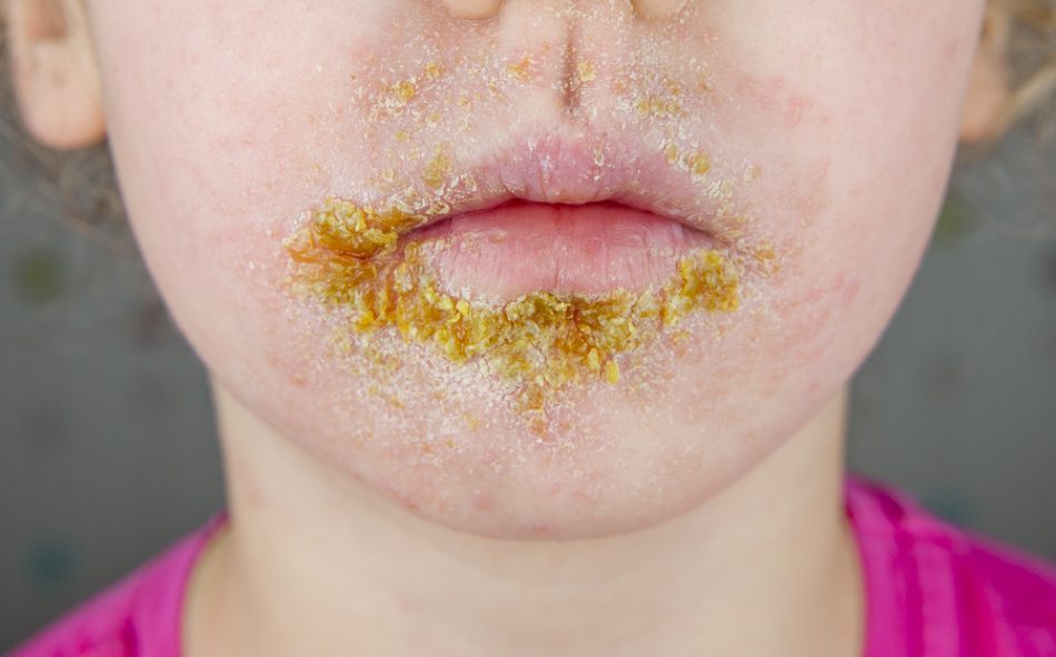 impetigine