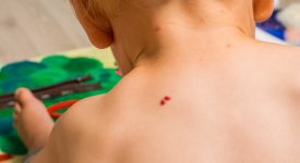 emangioma-infantile-nuove-cure