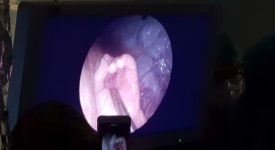 spina-bifida-curata-in-utero-due-rivoluzionari-interventi-eseguiti-a-milano