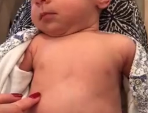 la-bronchiolite-di-una-bambina-in-un-video-diventato-virale-video