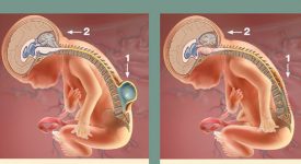 spina-bifida-corretta-in-utero-il-neonato-e-nato-sano-primo-caso-in-europa