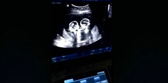 gemelline-giocano-nella-pancia-della-mamma