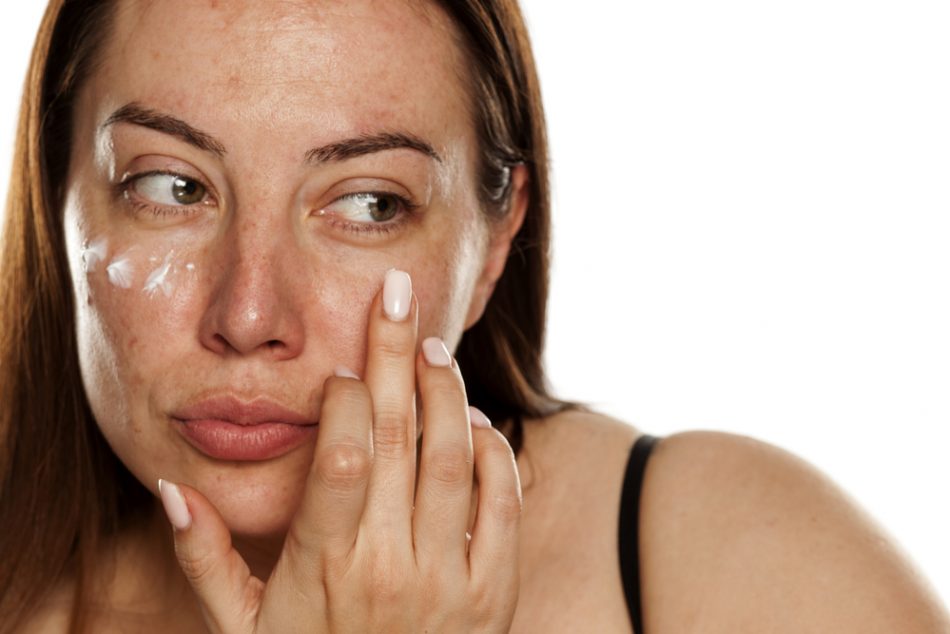 come-prevenire-maschera-gravidica