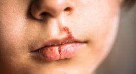 herpes-labiale-bambini