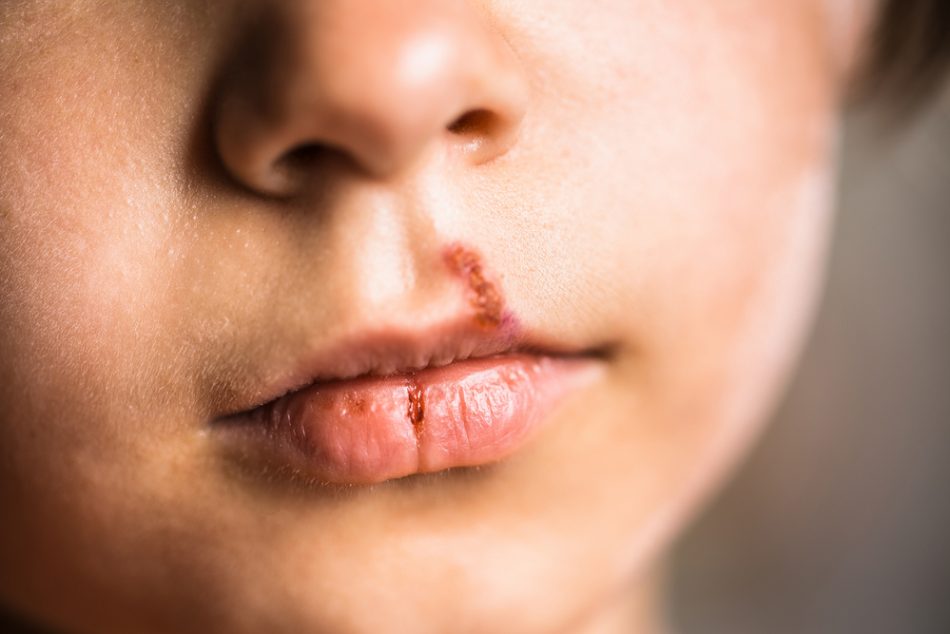 herpes-labiale-bambini