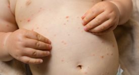 i-danni-postumi-del-morbillo-amnesia-immunitaria
