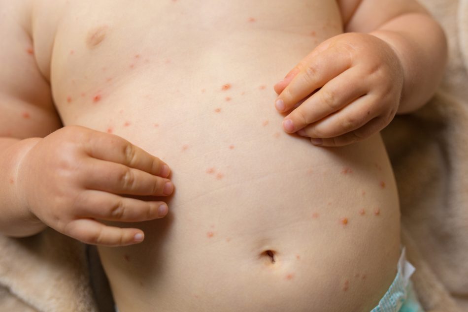 i-danni-postumi-del-morbillo-amnesia-immunitaria