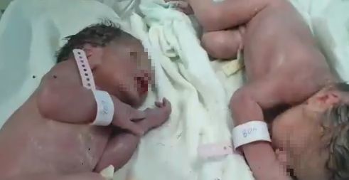 albania-due-gemelli-vengono-alla-luce-poco-dopo-il-sisma