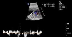 esami-di-diagnosi-prenatale:-amniocentesi-o-dna-fetale?
