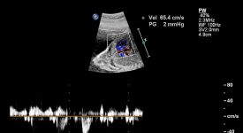 esami-di-diagnosi-prenatale:-amniocentesi-o-dna-fetale?