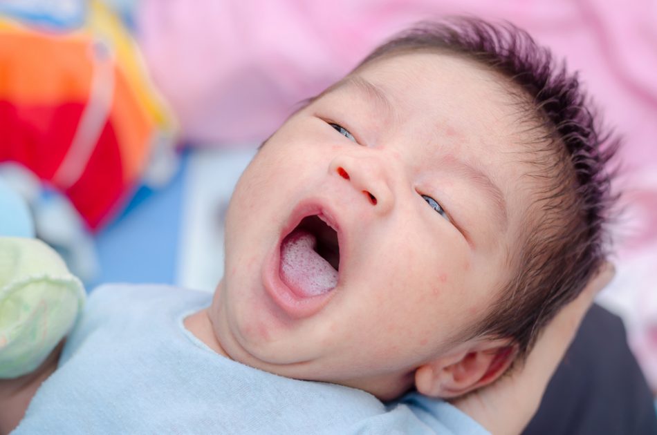 lingua-bianca-del-neonato