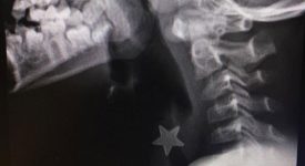 inala-una-stellina-di-metallo-che-si-blocca-in-trachea-intervento-al-niguarda-di-milano