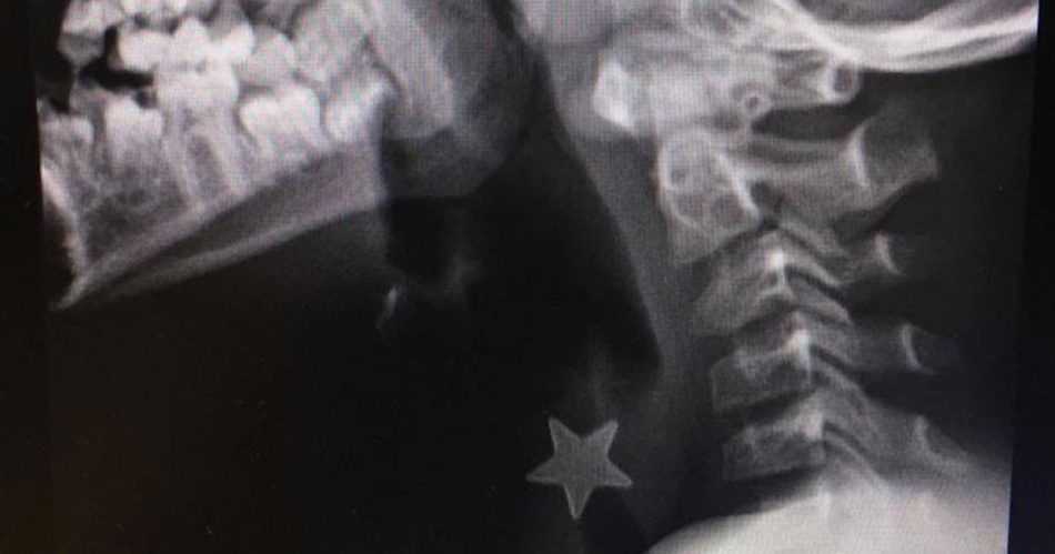 inala-una-stellina-di-metallo-che-si-blocca-in-trachea-intervento-al-niguarda-di-milano