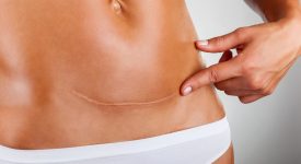 5-cose-da-sapere-sul-post-parto-cesareo