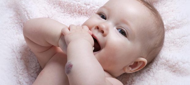 emangioma-infantile-cosa-e-e-come-riconoscerlo