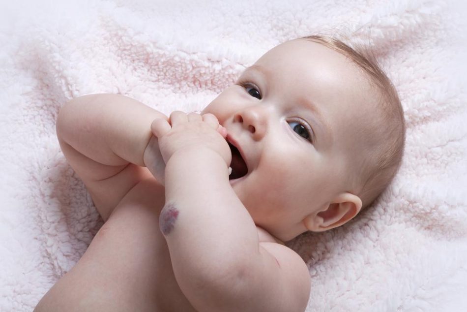 emangioma-infantile-cosa-e-e-come-riconoscerlo