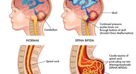 spina-bifida-cose-cause-sintomi-e-complicanze