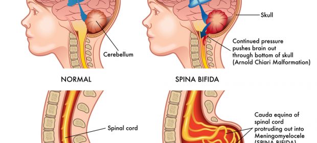 spina-bifida-cose-cause-sintomi-e-complicanze