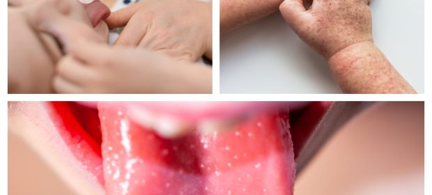 scarlattina-tutto-quello-che-ce-da-sapere