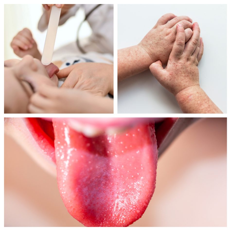 scarlattina-tutto-quello-che-ce-da-sapere