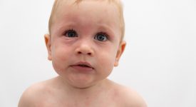 shock-anafilattico-nei-bambini-cose-e-come-si-manifesta