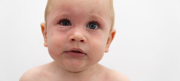 shock-anafilattico-nei-bambini-cose-e-come-si-manifesta